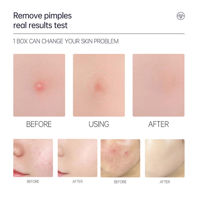 Pimple Patches (Hydrocolloid) – Invisible Acne Patch Concealer, 72pcs - Glowify